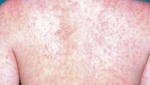 Case of measles disease confirmed in Mayo child