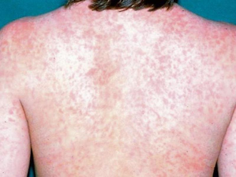 Measles case confirmed in Mayo